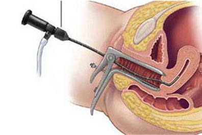子宫输卵管造影全过程