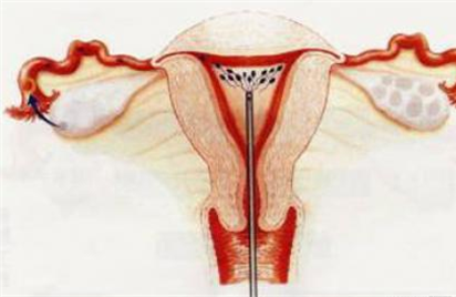 輸卵管疏通怎么做