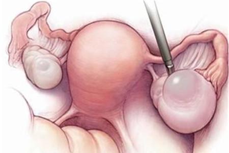 畸胎瘤是怎么形成的