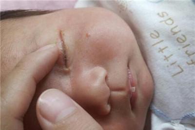 宝宝泪道堵塞怎么按摩