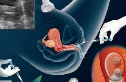 人工授精or试管婴儿，应该如何选择？