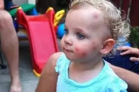 宝宝被蚊虫叮咬后，这6种方法能快速止痒！