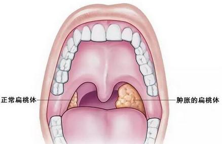 儿童扁桃体发炎怎么回事 如何预防？