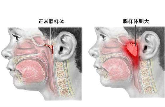 小儿腺样体肥大怎么办