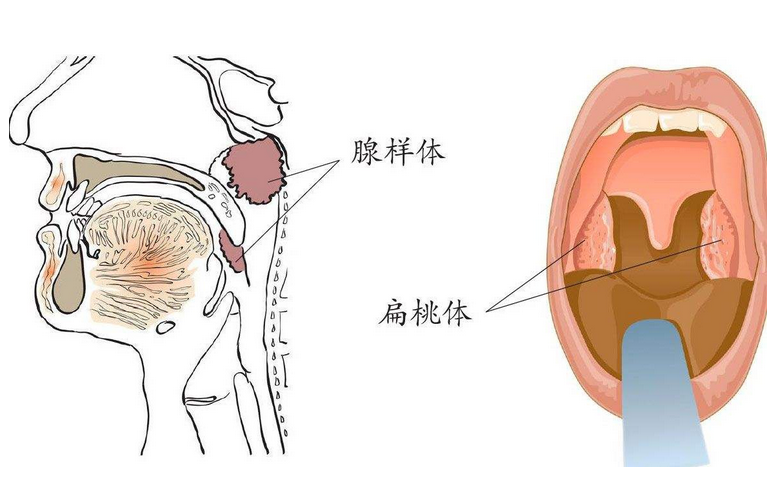 小儿腺样体肥大的危害