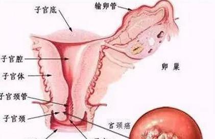 宫颈癌治疗方法的选择，手术？放疗？
