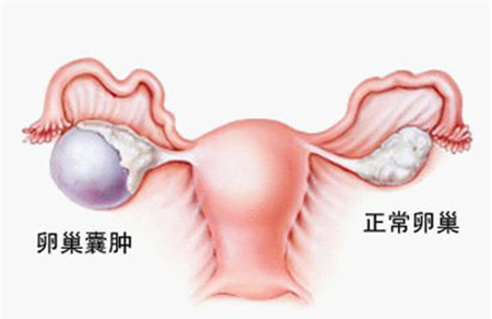 卵巢囊肿是怎么引起的