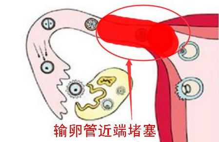 输卵管不通？别哭，这几种办法帮你成功怀孕！