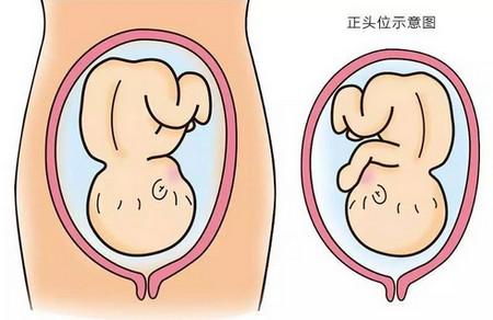 如果胎位不正，就只能剖宫产吗？