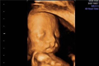 24周胎儿四维彩超