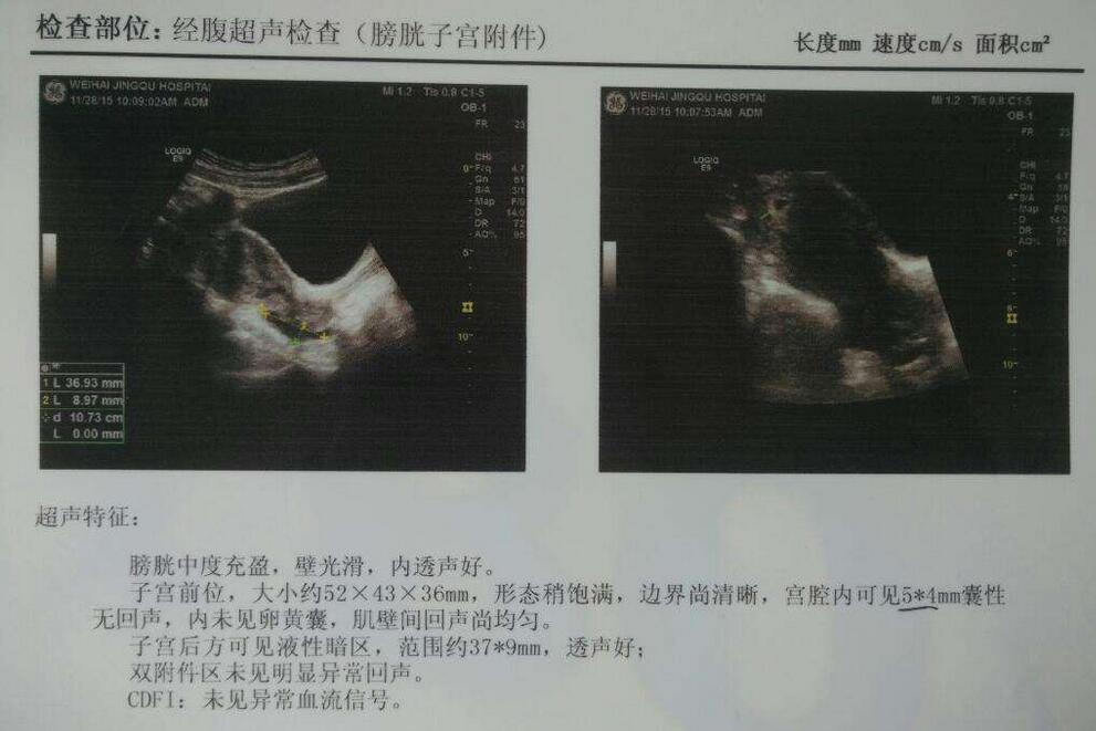 怀孕45天孕囊大小标准