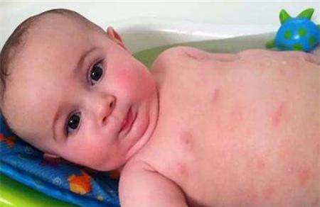 宝宝湿疹症状图片有哪些