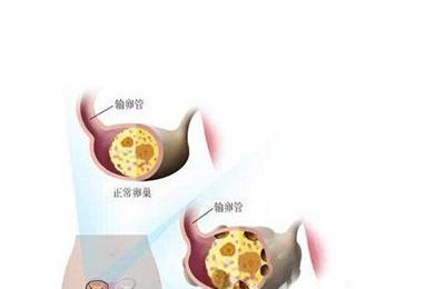 多囊卵巢综合症减肥