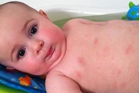 宝宝吃鸡蛋过敏症状