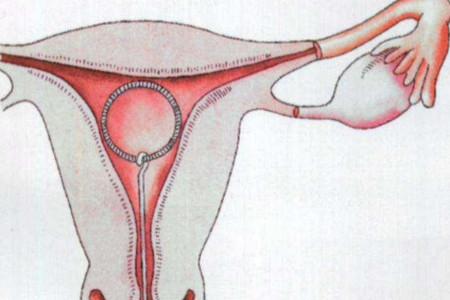 婴儿“手握”避孕环出生，带环怀孕的真相是…