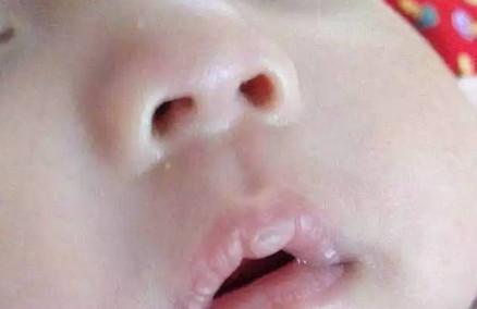 宝宝嘴唇干不一定是缺水，可能是病！