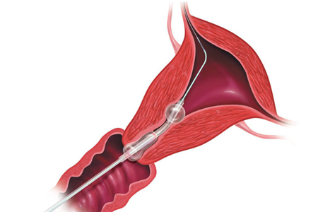 输卵管造影过程