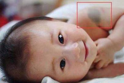 避免宝宝身上长胎记，孕期这几点一定要避免，千万不能忽视！