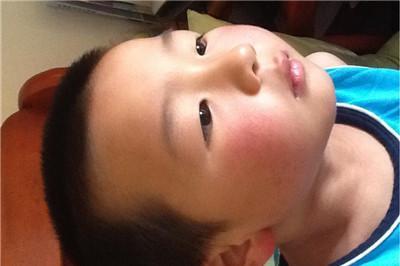 儿童颈部淋巴结肿大