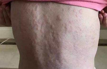 蚊子包、螨虫包、荨麻疹、痱子or湿疹，夏日最困扰宝宝的皮肤问题，你搞清楚了吗？