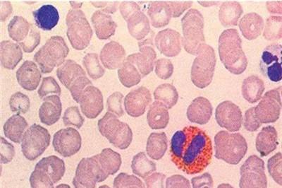 白血球高是怎么回事 小心是这几种病找上你！