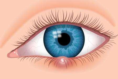 小儿麦粒肿的中医治疗方法 药膳调理效果好