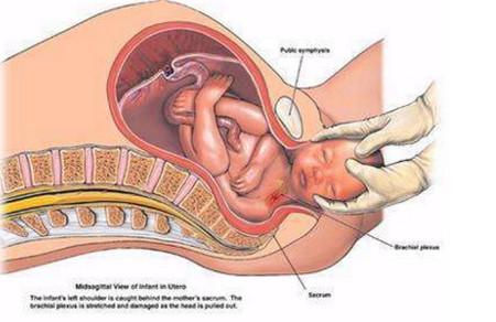 顺产时最可怕的一项意外！胎头生出了也得塞回剖腹产！