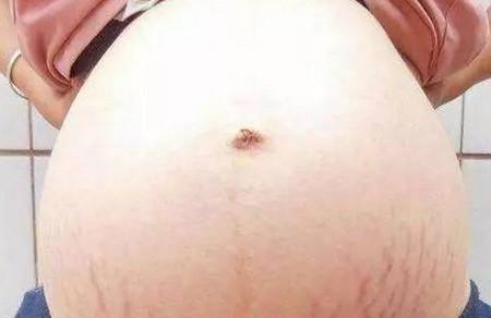 妊娠纹可以判断生男生女? 妊娠纹几个月会出现? 如何预防?