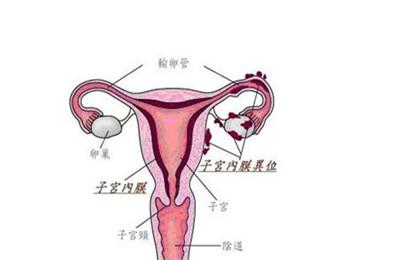 子宫腺肌症能怀孕吗 不孕几率多大?
