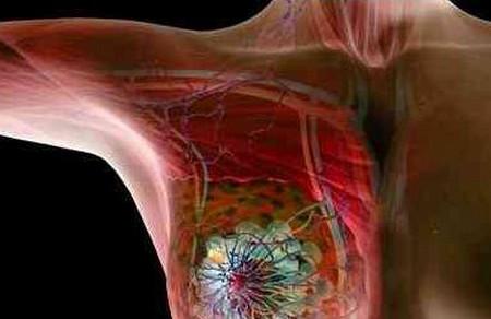 医生说你乳腺增生，你就紧张了？