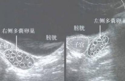 什么是多囊卵巢综合征？教你认识多囊卵巢综合征