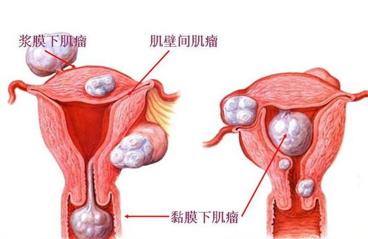 什么是子宫肌瘤？子宫肌瘤的那些事儿