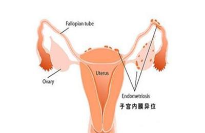 子宮內(nèi)膜增厚的原因 子宮內(nèi)膜增厚可能是腫瘤嗎?