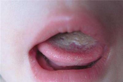 最管用的鹅口疮土方 这样做超级管用