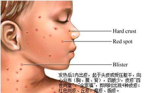 小儿风疹的症状和治疗 宝宝风疹的表现有哪些