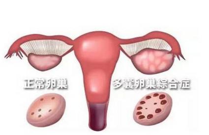 多囊卵巢究竟是怎么影响怀孕的？又该怎么好孕呢？
