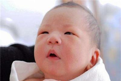 奶藓怎么消除 消除奶藓这几点要警惕