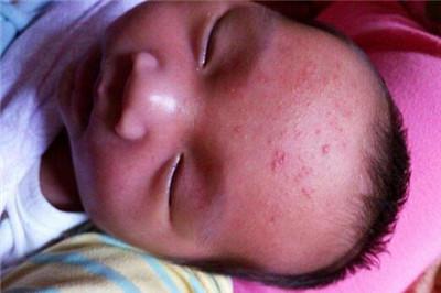 奶藓擦什么药膏好 奶藓的注意事项