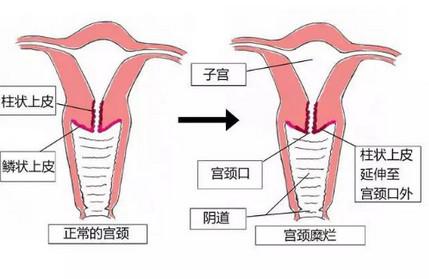 别再被宫颈糜烂吓倒了，根本不是病！