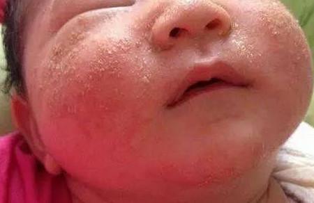 宝宝脸上几乎“毁容”，到底长的什么？ 看着真心疼！