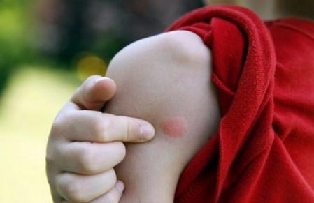 夏天要警惕的毒虫，除了该死的蚊子还有这4种！