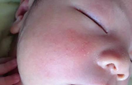 婴幼儿湿疹那么常见，怎么保护自家宝宝？