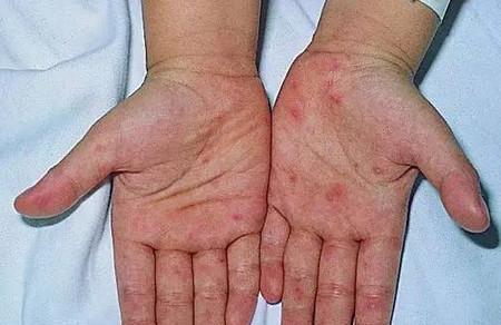 手足口病来袭，如何保护您的宝宝？