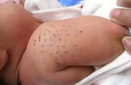 婴儿吵夜母亲用土法拔“毒刺” 儿科专家：并不靠谱