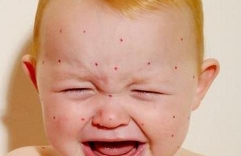 宝宝眼睛被蚊子咬了怎么消肿 夏季驱蚊妙招大全