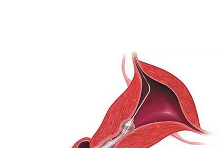 准备生二胎，输卵管堵了怎么办？