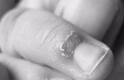 宝宝长倒刺到底是缺什么？教你3招正确护理