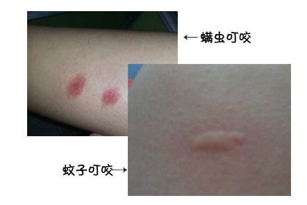 宝宝被螨虫叮咬后的症状图片 教你辨别螨虫引起的过敏症状