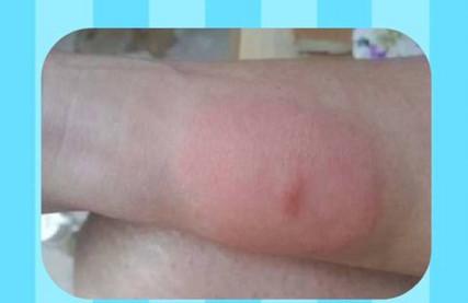 宝宝被蚊虫叮咬后，抹什么能快速止痒？