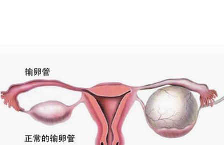 浅析关于卵巢囊肿的早期症状！